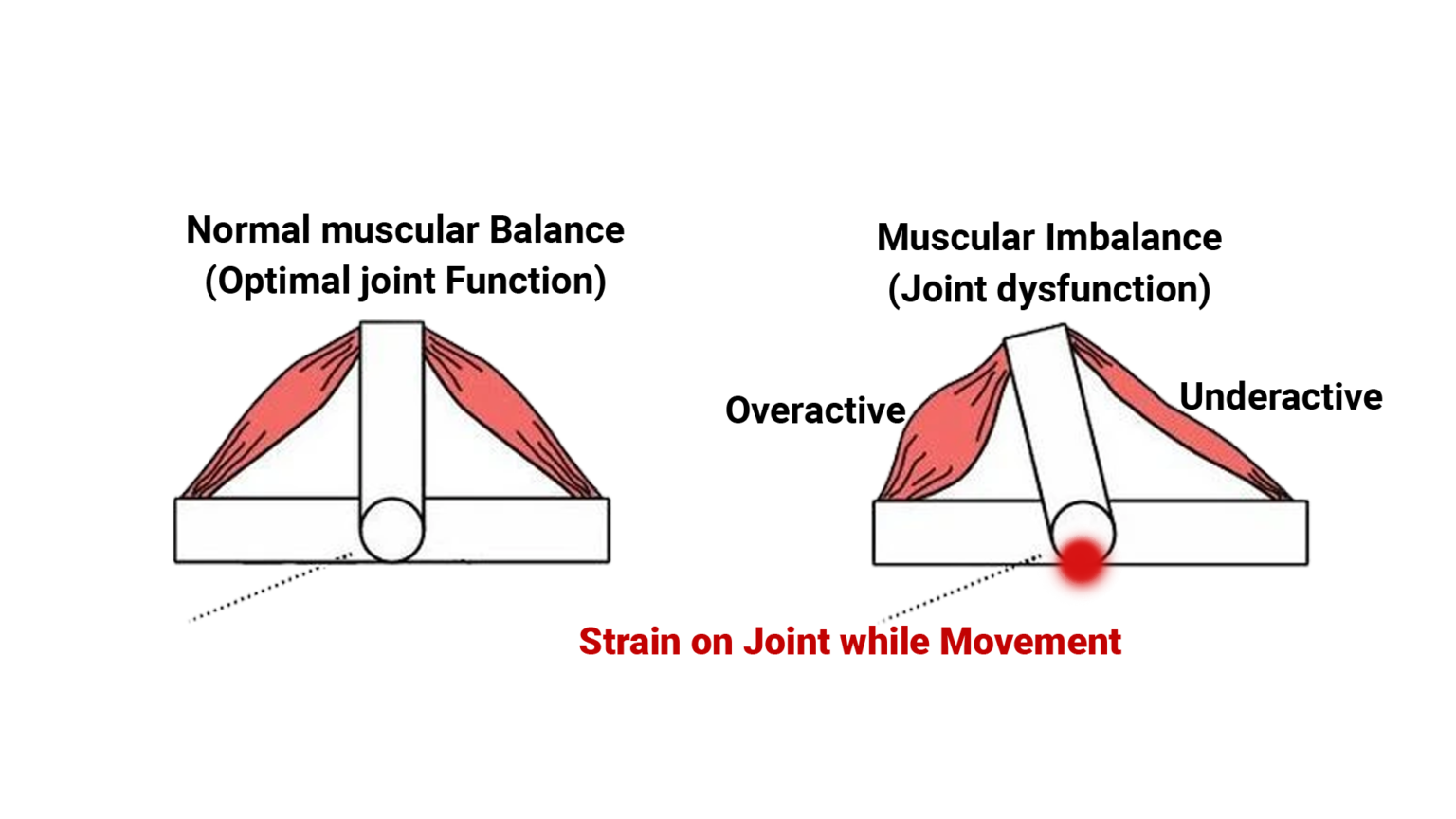 Muscle Imbalance Dr. Amit Sarswat
