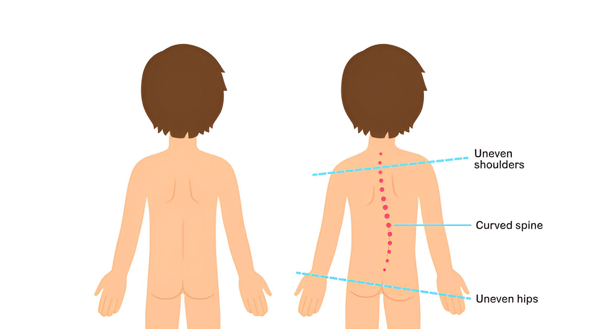 posture problem in kids